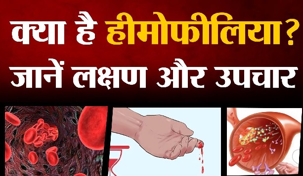 What is Haemophilia?, Know its symptoms and treatment