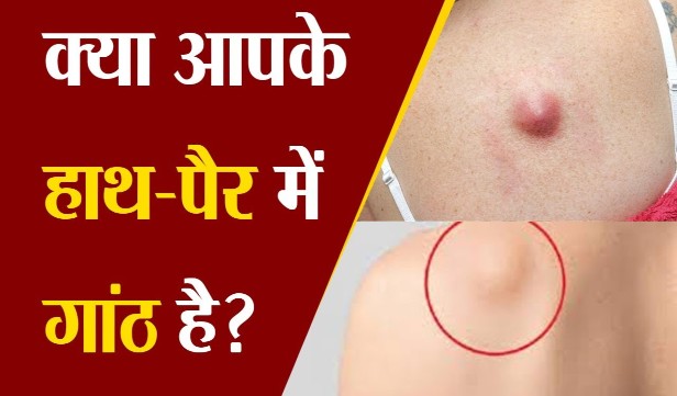 Do you have lumps in your hands and feet?